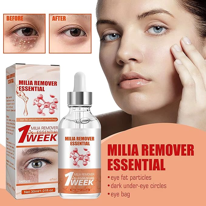 MiliaClear Treatment Kit: Fast Milia Removal Solution 30Ml (4pc)