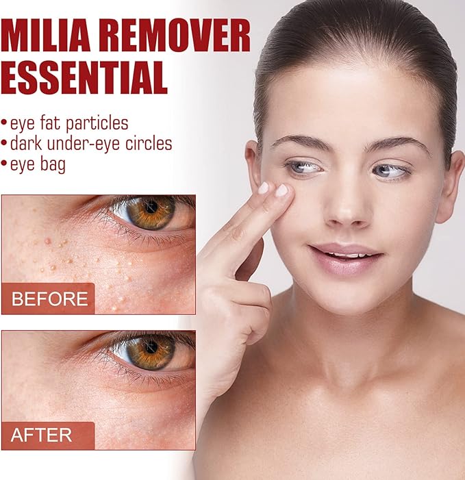 MiliaClear Treatment Kit: Fast Milia Removal Solution 30Ml (4pc)