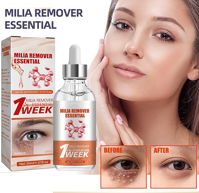 MiliaClear Treatment Kit: Fast Milia Removal Solution 30Ml (4pc)